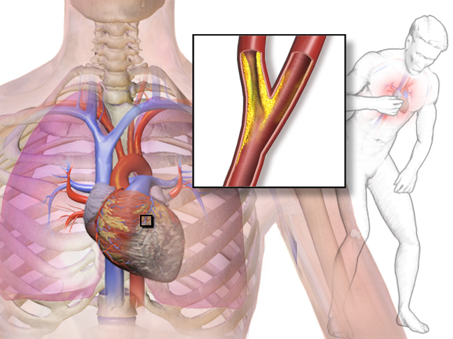 krūtinės angina hipertenzijos fone