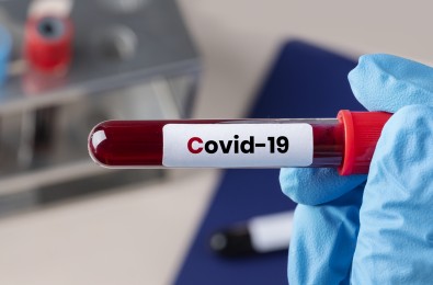 Viskas apie serologinį COVID-19 IgG antikūnų tyrimą vienoje vietoje!